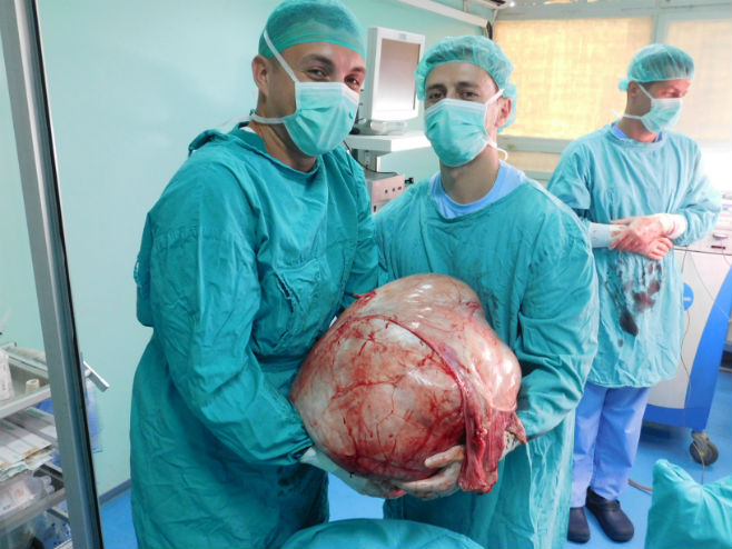 Бањалучки доктори одстранили тумор тежак 31 килограм - Фото: РТРС
